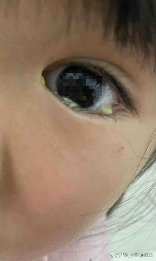 小孩一只眼睛一直流眼水有眼屎缩略图