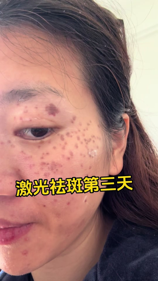 激光祛斑视频游戏截图