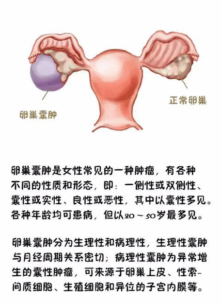 卵巢囊肿有什么症状和危害缩略图