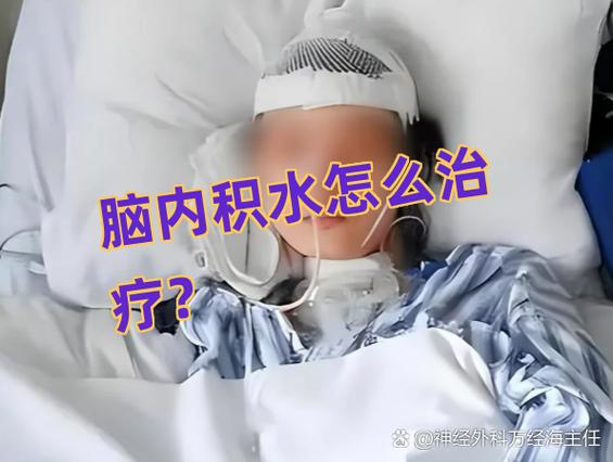 脑积水分流术后注意事项缩略图