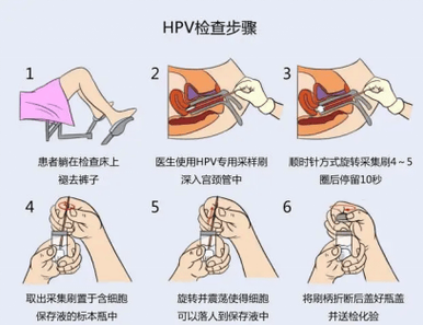 hpv核酸检测怎么检查缩略图