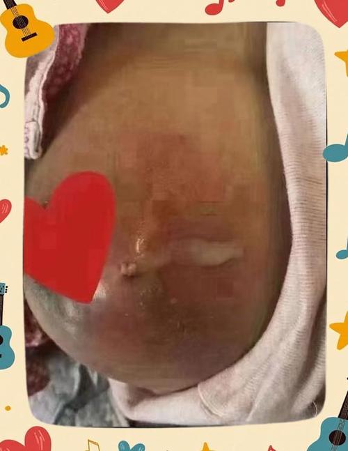 哺乳期乳头刺痛,像针扎缩略图