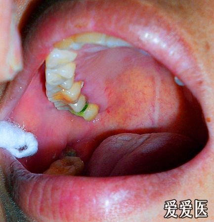 腿部皮肤出现红色斑块图片缩略图