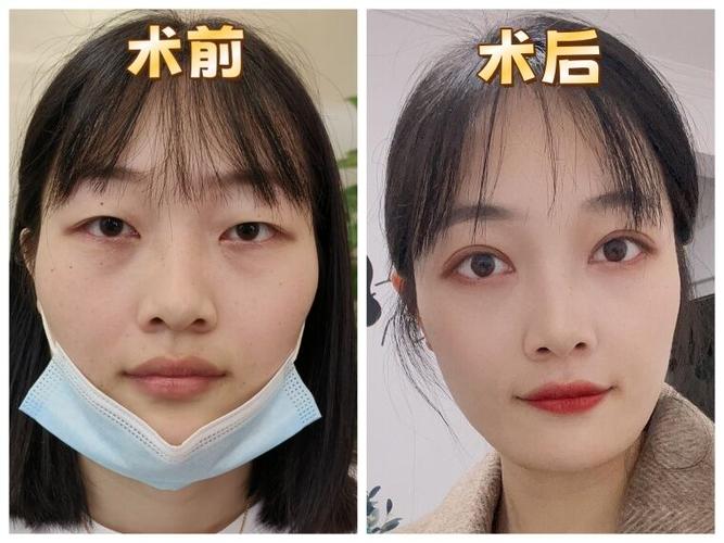 幽默回复别人说你割双眼皮缩略图