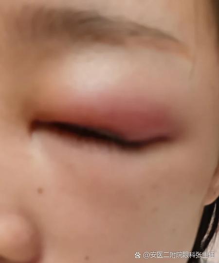 过敏眼睛肿脸肿怎么快速消除缩略图