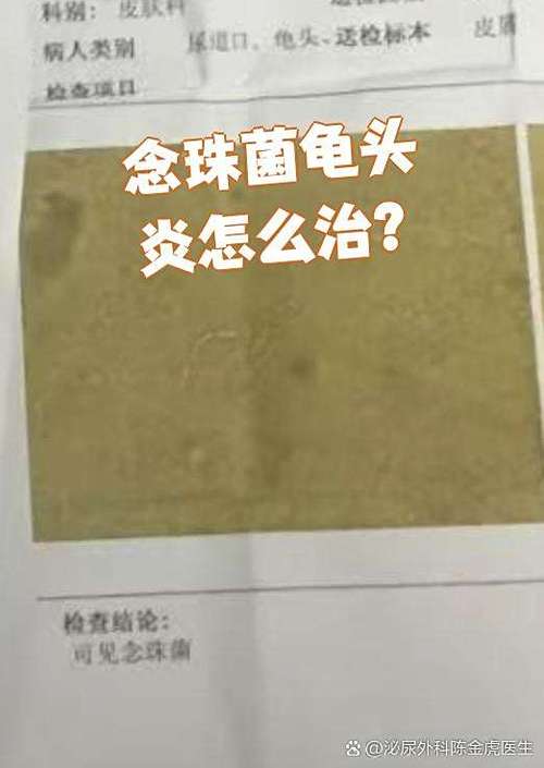 念珠菌感染什么症状缩略图