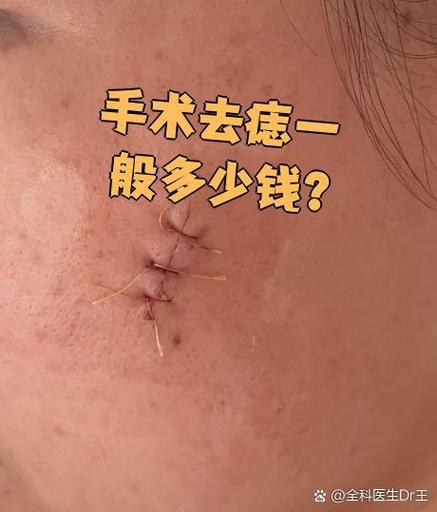 济南军区总医院祛痣缩略图