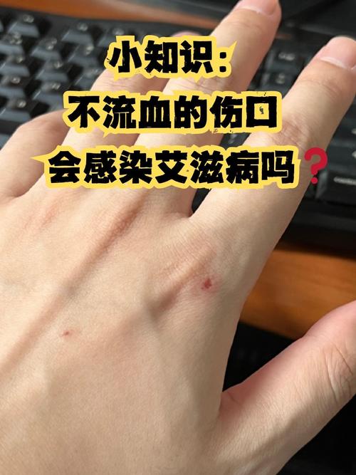 购买艾滋病检测试纸缩略图