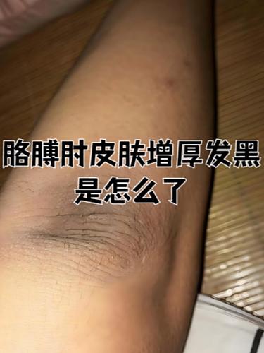 皮肤变黑的原因缩略图