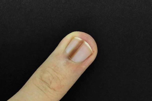 指甲黑色竖纹是什么病缩略图