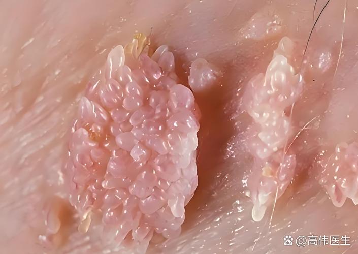hpv照片长什么样缩略图