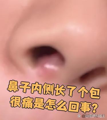 鼻子里有个疙瘩一摸就疼缩略图