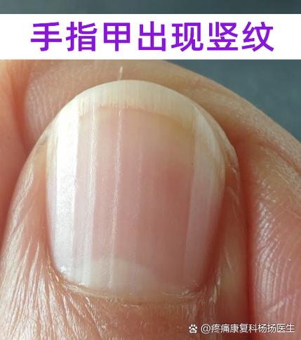 大拇指有竖纹是什么病游戏截图
