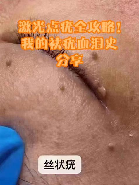 1个疣体激光一次多少钱缩略图