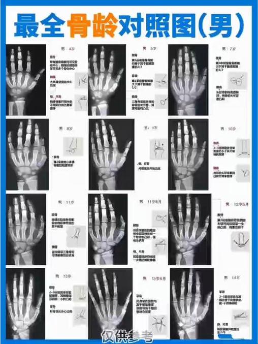 骨龄与身高对照表2017缩略图