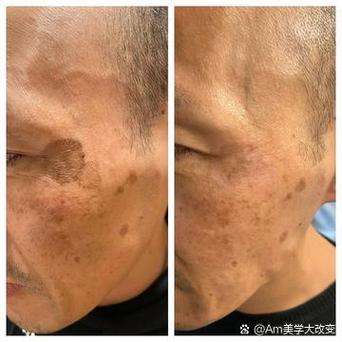 老年斑去医院看什么科缩略图