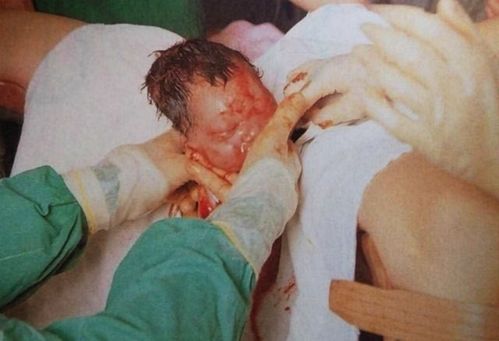 孕妇生孩子生不出来缩略图