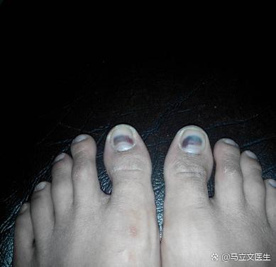 指甲有黑色竖纹是肝病吗缩略图