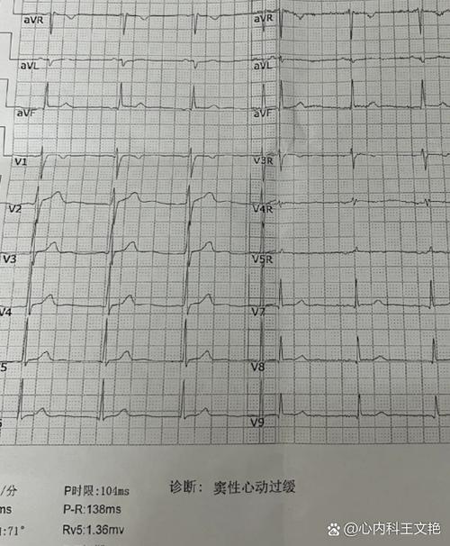 心率40-50缩略图