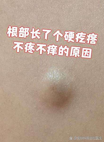 长了个硬疙瘩图片缩略图