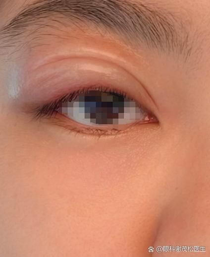 眼皮水肿是什么原因引起的游戏截图