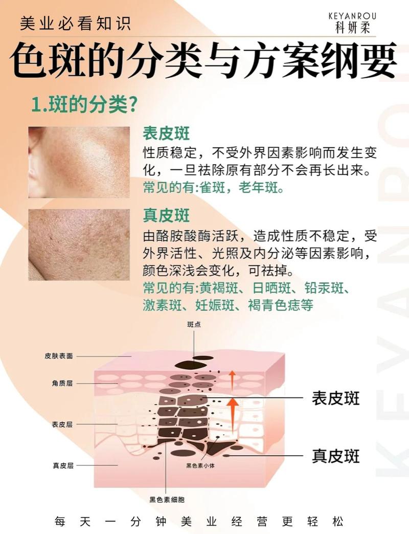 皮肤色斑形成的原因缩略图