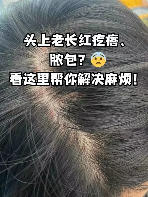 头皮红疙瘩缩略图